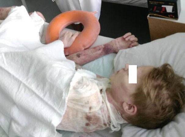 Получивший ожоги во время селфи мальчик хочет спасать других детей