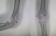 В Саратовской области подростку во время игры прострелили руку из пневмата