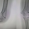 В Саратовской области подростку во время игры прострелили руку из пневмата