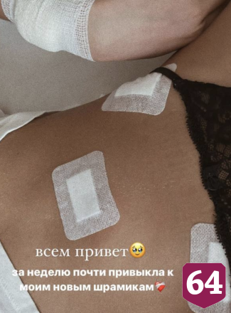 Невестке саратовской певицы вырезали крупную опухоль
