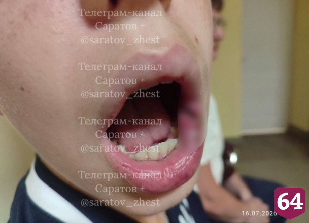 На дачах под Энгельсом избили подростка