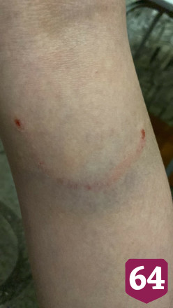 В Саратове собака покусала 11-летнюю девочку