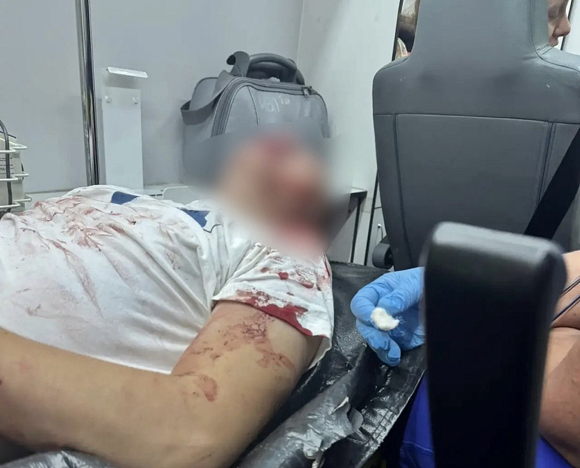 В Саратовской области посетитель бара пострадал после конфликта с охранником