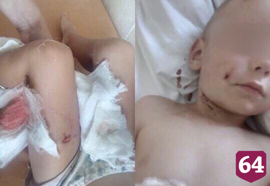 Детский омбудсмен свяжется с матерью покусанного алабаем ребенка