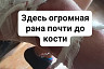 В сквере Саратова бездомная собака покусала 8-летнего мальчика