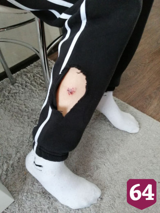 Под Саратовом стая собак искусала 14-летнего школьника
