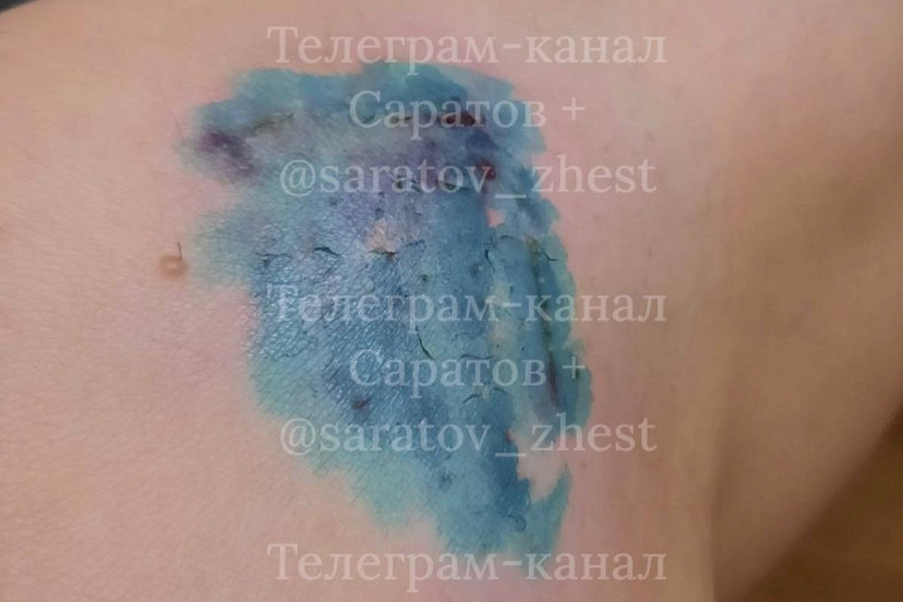 В Саратове бродячая собака прокусила женщине ногу