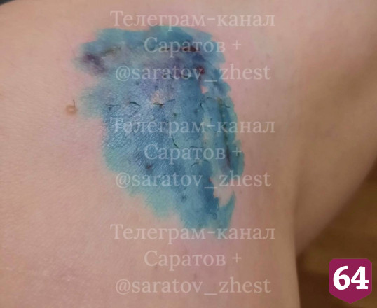 В Саратове бродячая собака прокусила женщине ногу